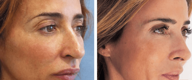 Antes y después de nariz de María Patiño.| Imagen: Youtube/Clinicas Diego de León