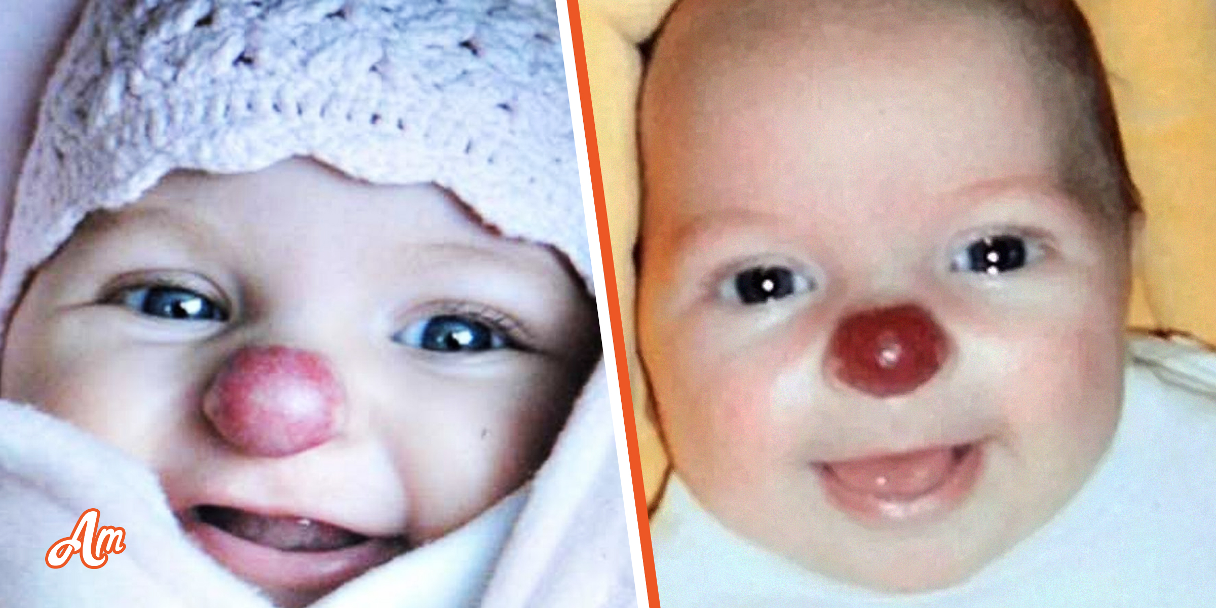 Girl Born with Red Nose Was Cruelly Called ‘Rudolph’ for It