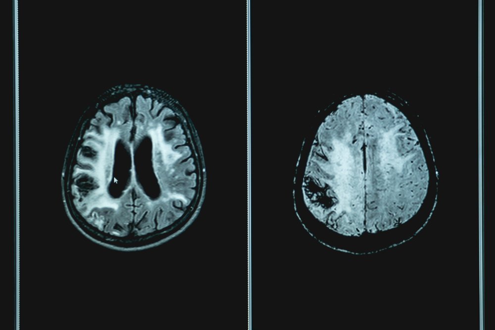 Vacular dementia MRI brain scan | Photo: Shutterstock