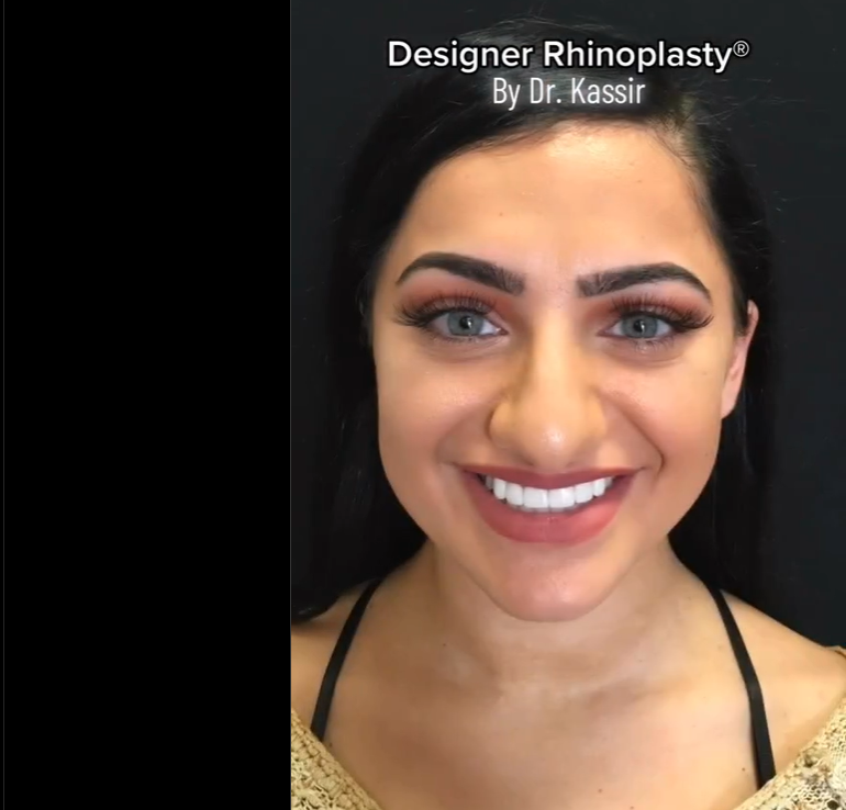 Amanda Haddad pictured before rhinoplasty, dated December 13, 2022 | Source: Instagram/drkassir