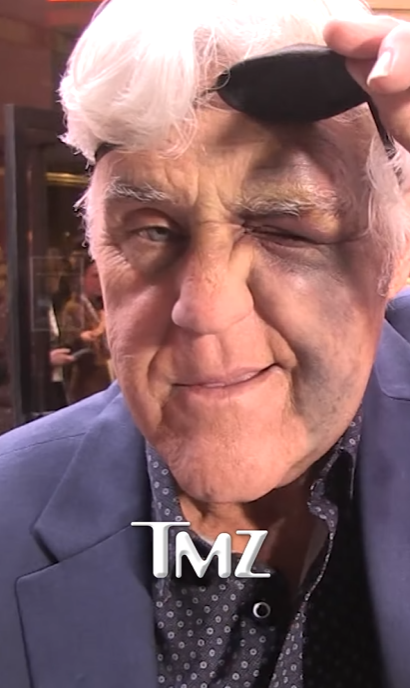 Jay Leno shows his black eye under the eye patch, posted on November 19, 2024 | Source: Instagram.com/tmz_tv