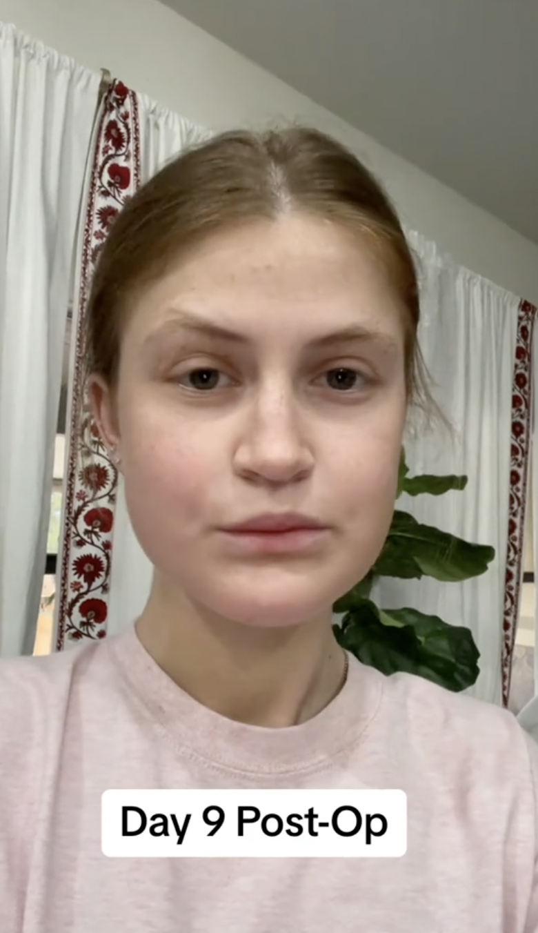 Virginia Elder posts a forward-facing photo on Day 9 with subtle healing progress. | Source: TikTok/virginiaeelder