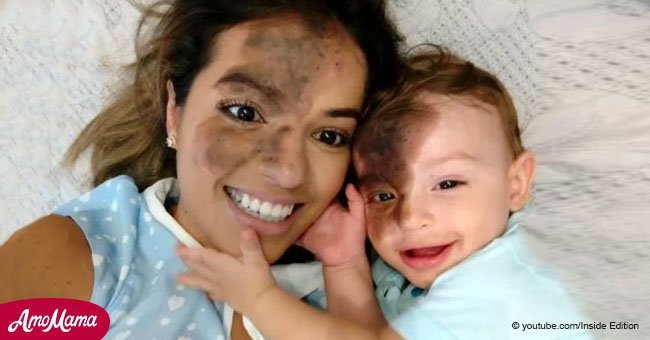 Mother replicates her son's facial birthmark to make him feel normal