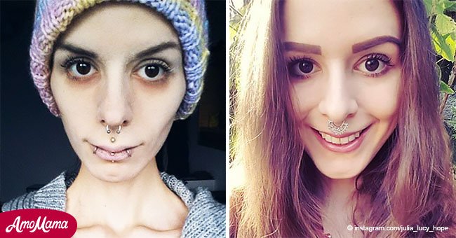 Anoréxica solía esconder comida tras sus orejas: aquí está su increíble transformación