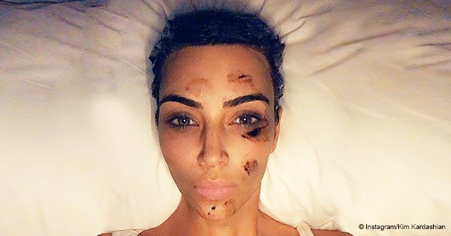 Kim Kardashian looks creepy after applying herbal ointment to treat psoriasis flare-up