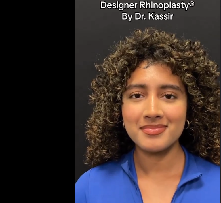 Photo of the patient after rhinoplasty, dated August 24, 2023 | Source: Instagram/drkassir