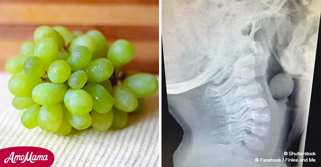 Terrifying x-ray of 5-year-old reveals why kids should never eat grapes unsupervised