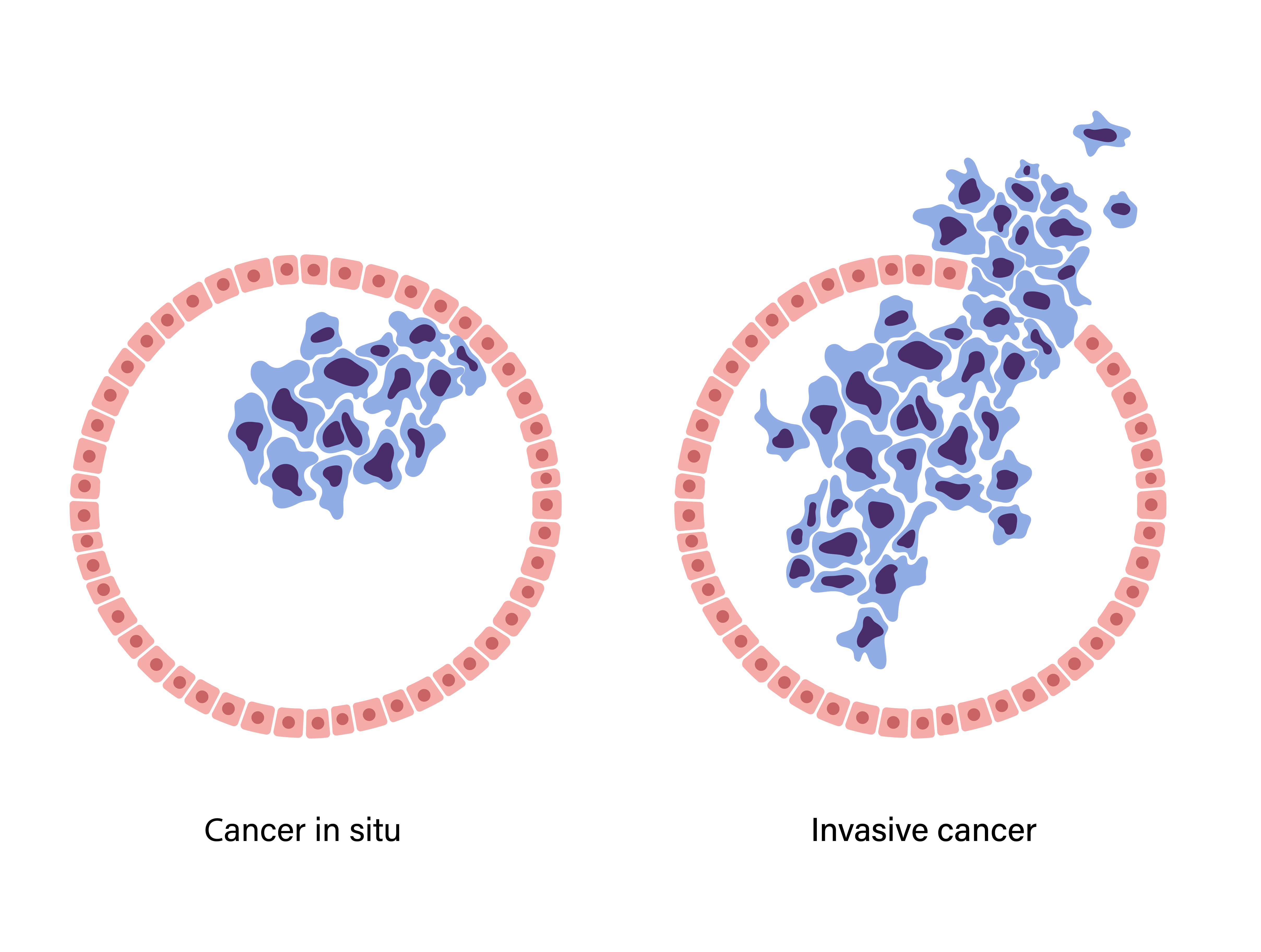 Visual representation of how breast cancer cells form and spread within breast tissue | Source: Getty Images