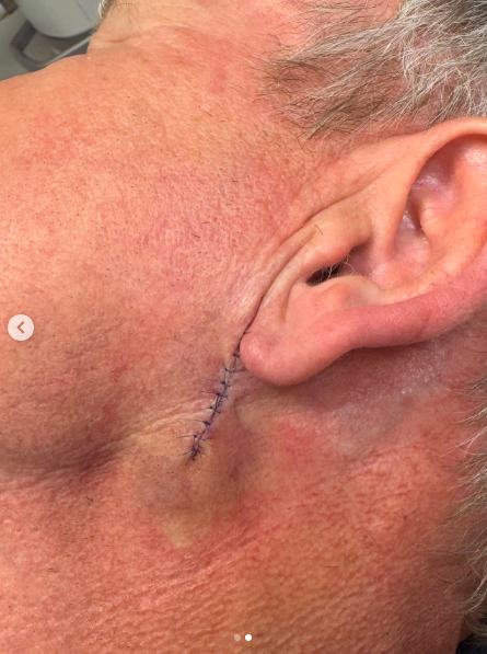 A close-up view of Gordon Ramsay's surgery scar, posted on August 30, 2025. | Source: Instagram/gordongram