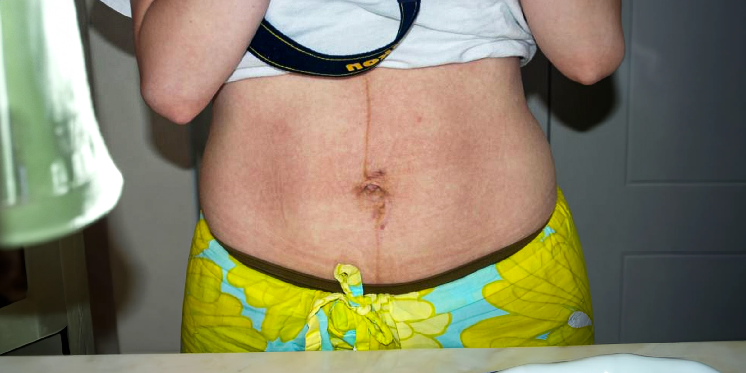 A woman's belly with stretch marks | Source: Flickr