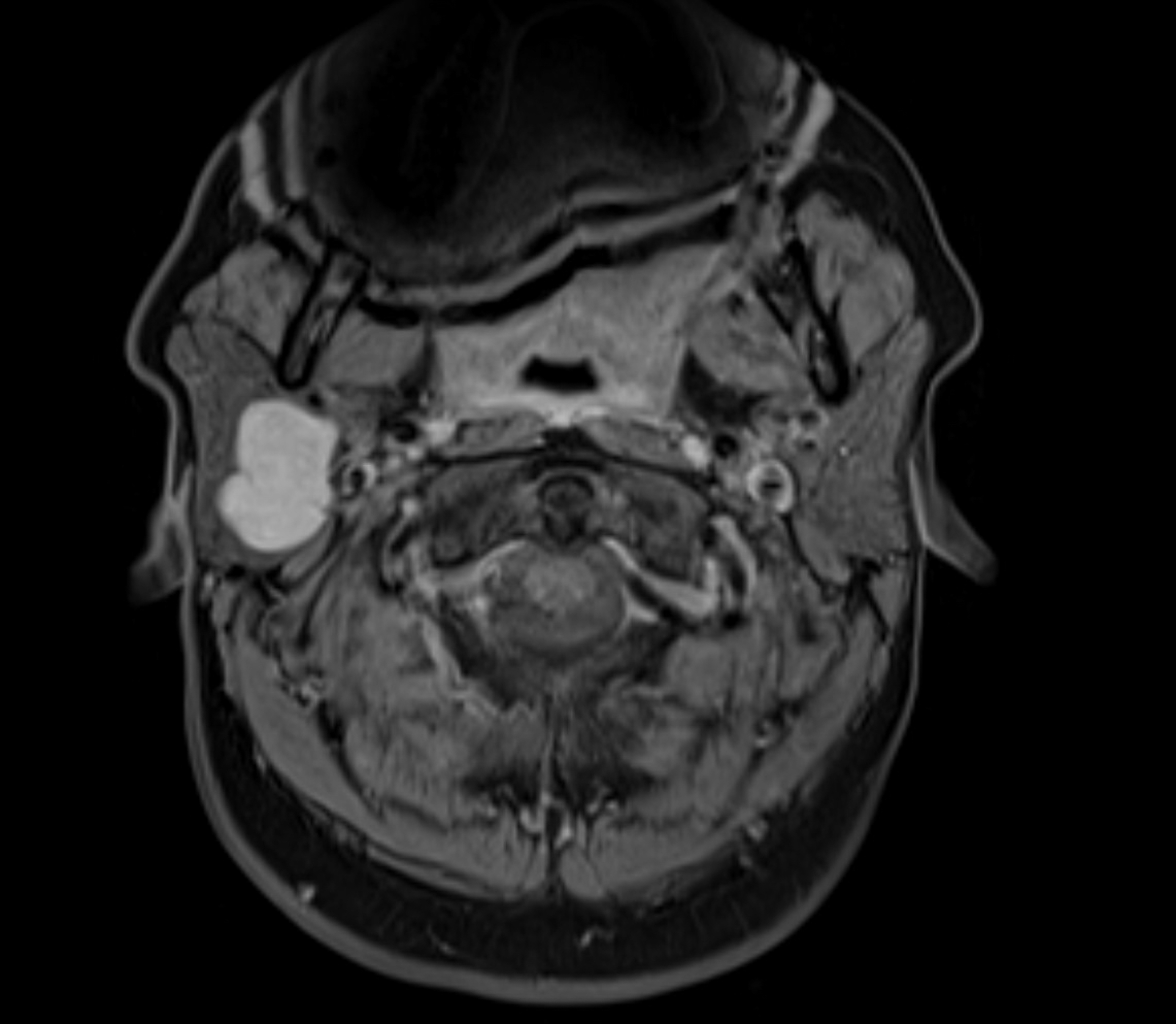 Axial multiparametric MRI scan showing a parotid gland tumor | Source: Getty Images