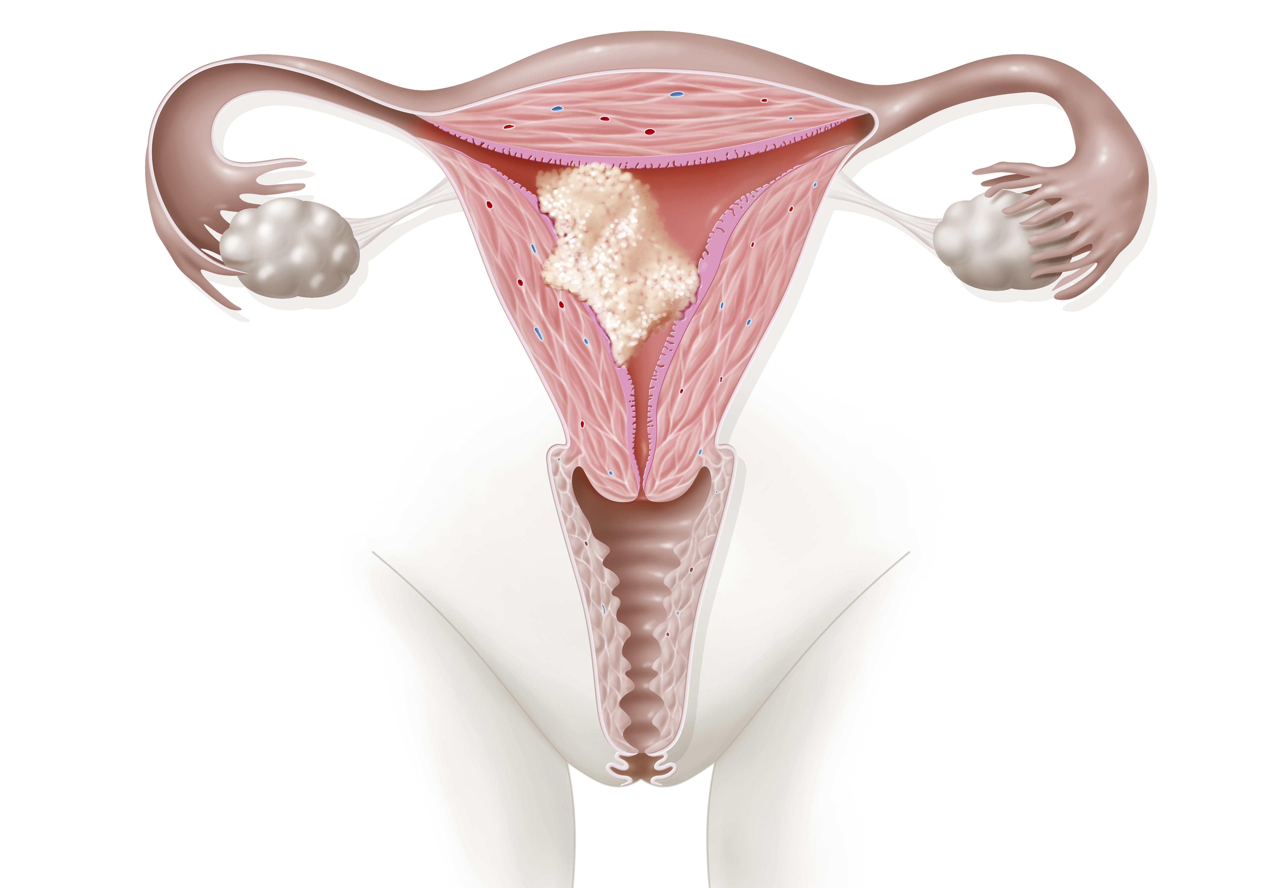Illustration of endometrial (uterine) cancer showing a tumor that has spread into the uterine muscle but not yet reached the cervix. | Source: Getty Images