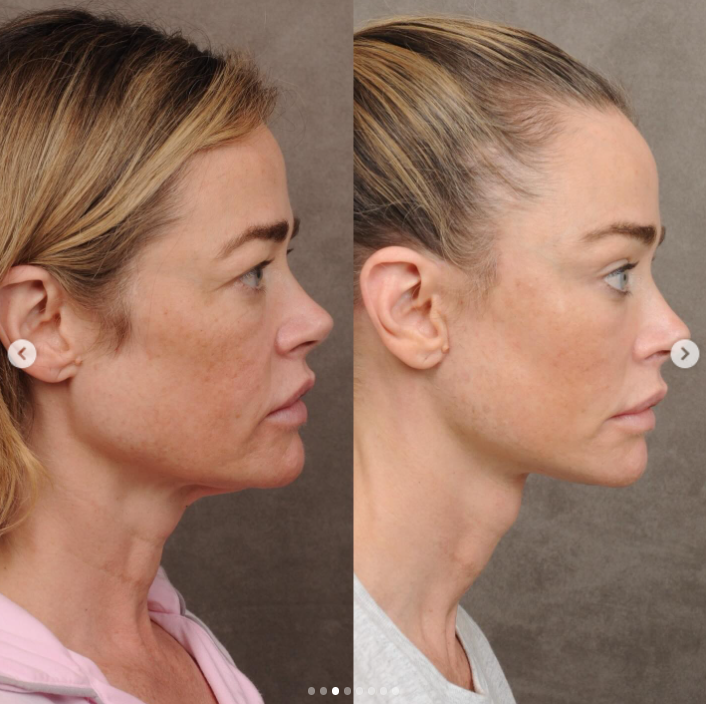 Denise Richards' before and after — Profile (side) view | Source: Instagram/drbentalei | deniserichards