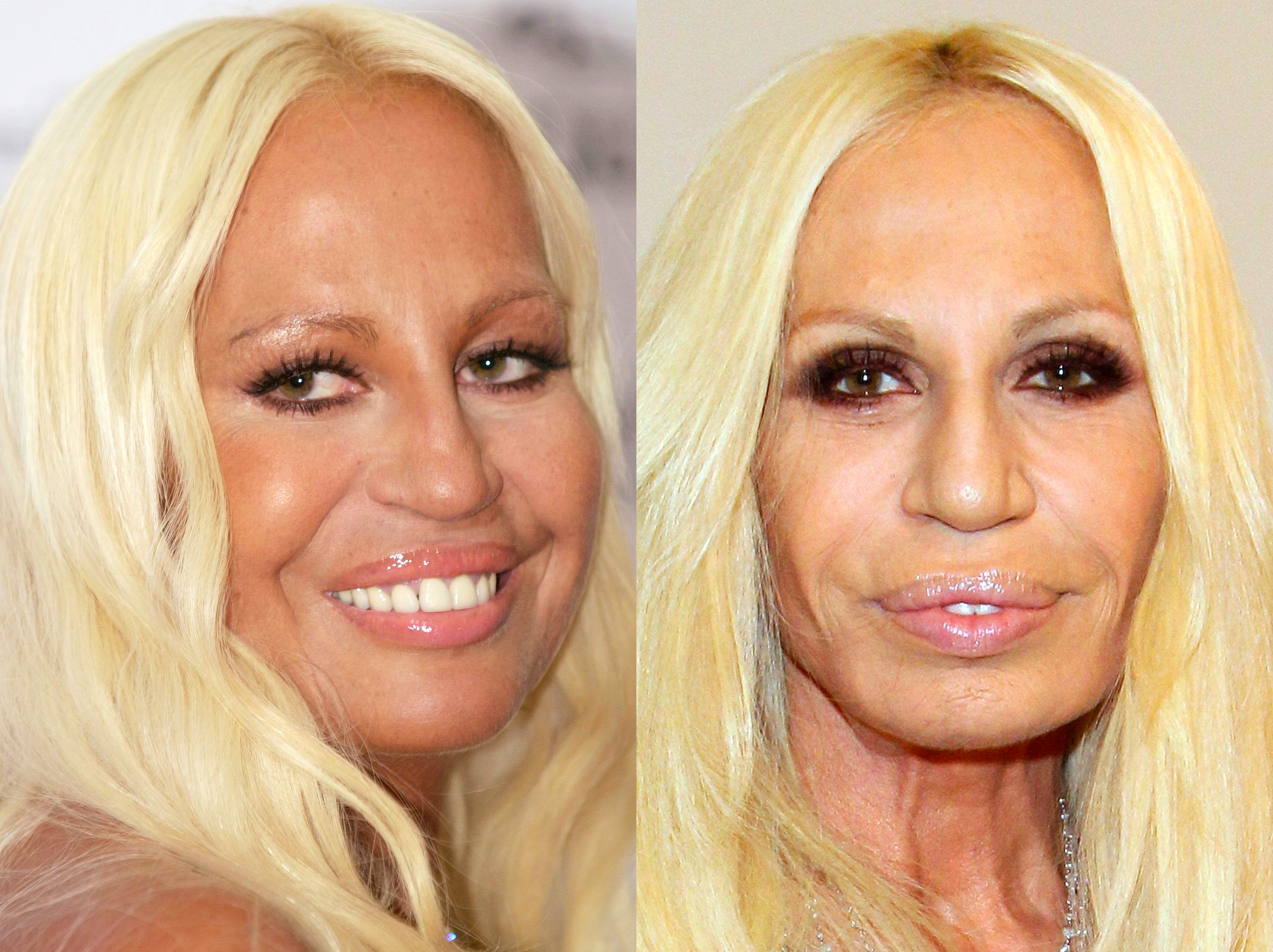Donatella Versace in 2001 vs 2010 | Source: Getty Images