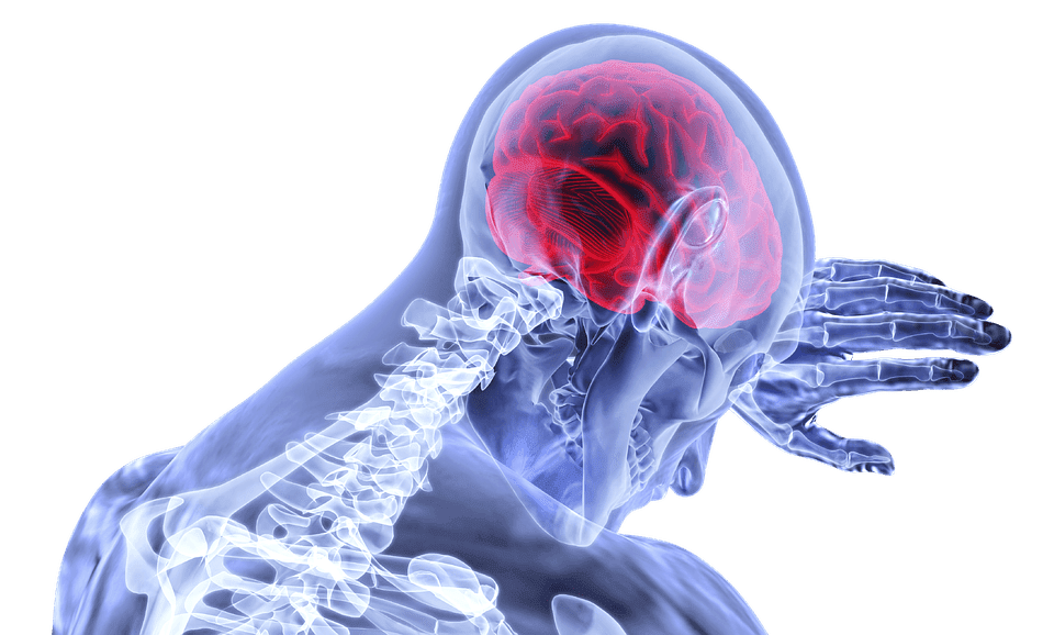 Accidente cerebrovascular. | Imagen: Pixabay Accidente cerebrovascular. | Imagen: Pixabay