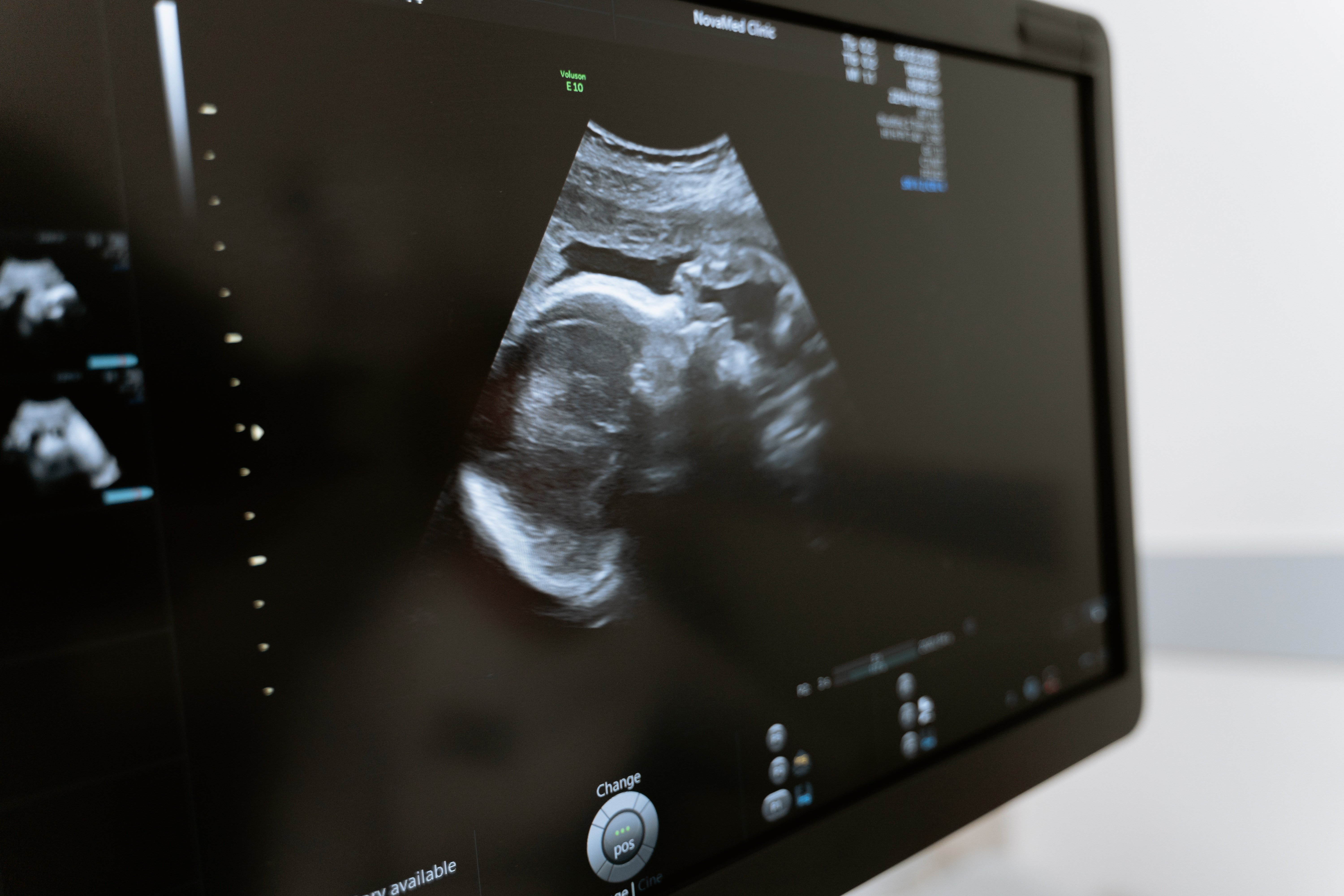 An ultrasound picture on a computer screen | Source: Pexels