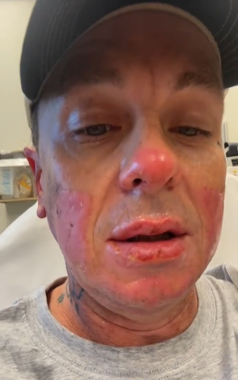 Screenshot of Sid Wilson's face after an explosion that left him sustaining serious injuries | Source: Instagram/sidthe3rd