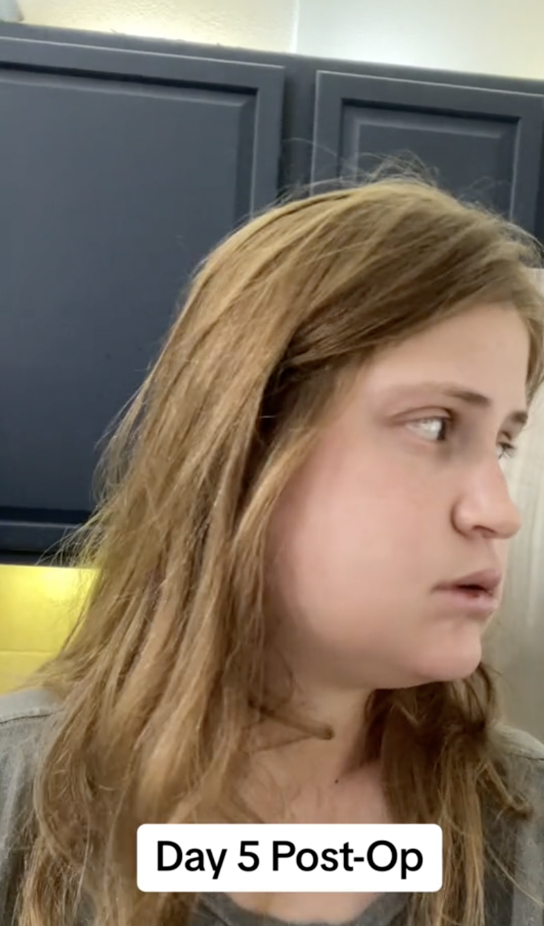 A side profile of Virginia Elder as she adjusts to her new jaw alignment. | Source: TikTok/virginiaeelder