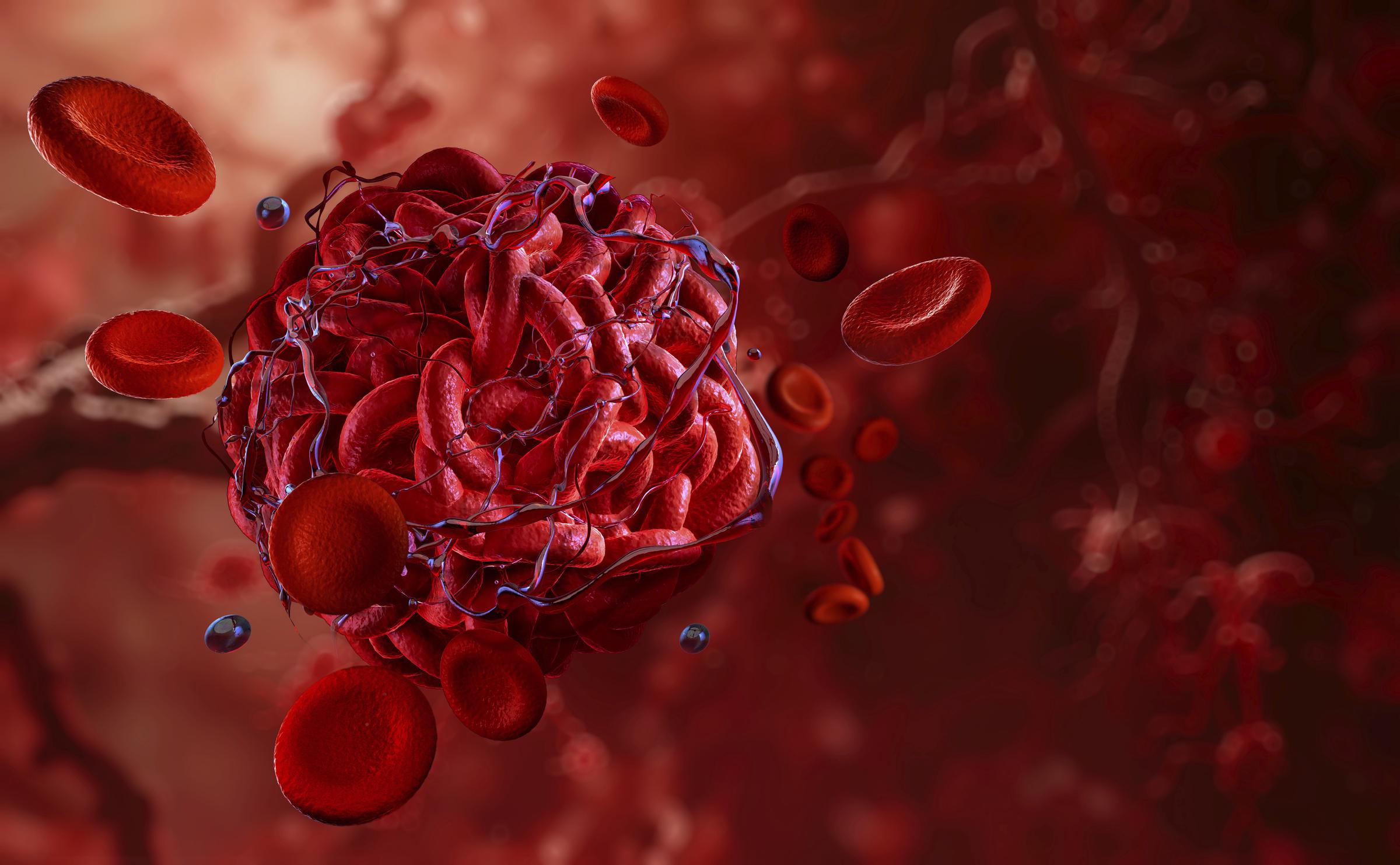 A stock illustration of a blood clot within an artery, showing red blood cells and fibrin strands | Source: Getty Images