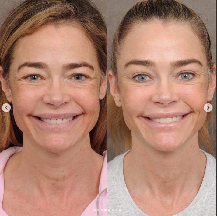 Denise Richards' before and after — Frontal view (smiling) | Source: Instagram/drbentalei | deniserichards