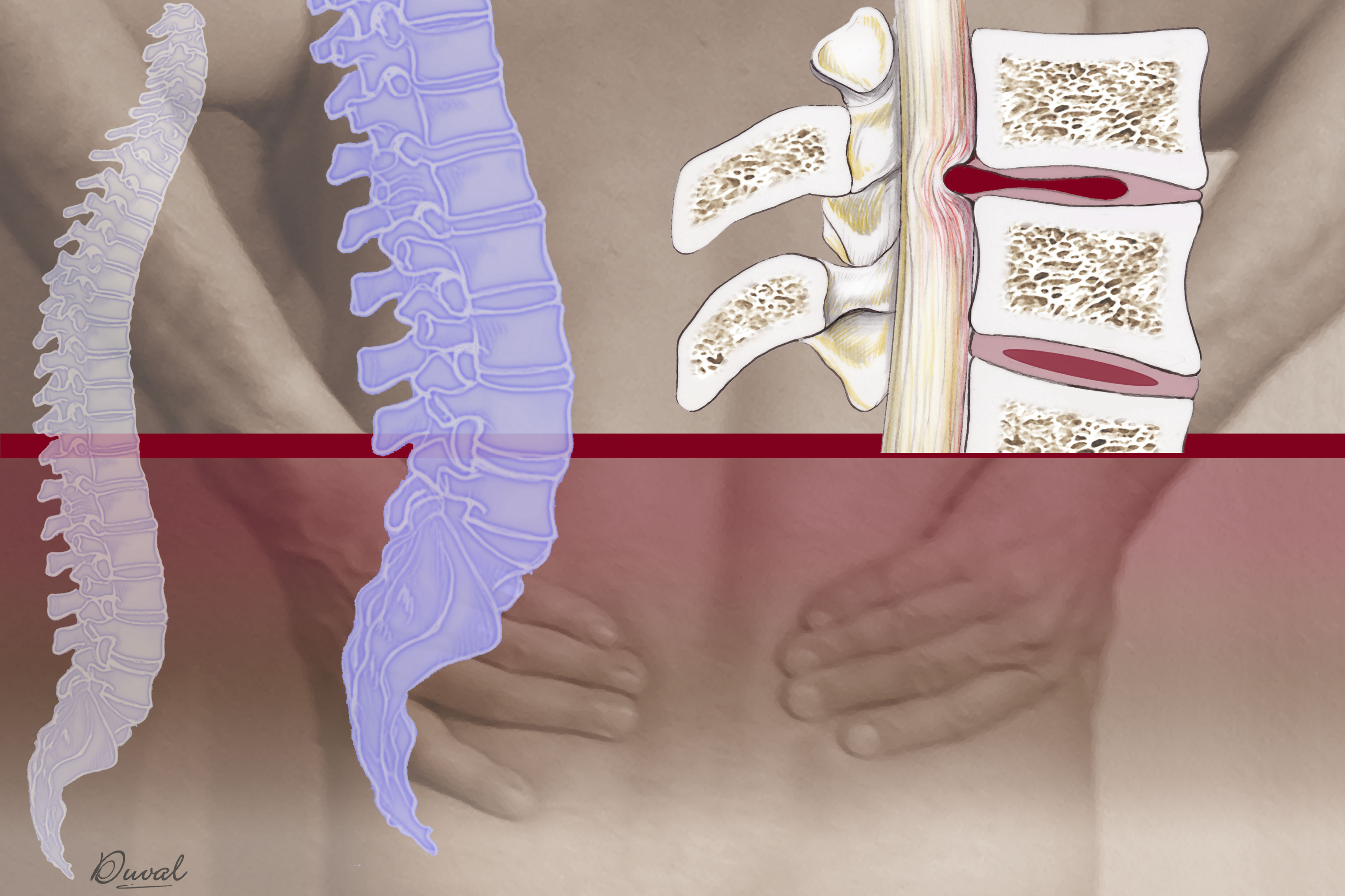 Illustration of a herniated disk | Source: Getty Images