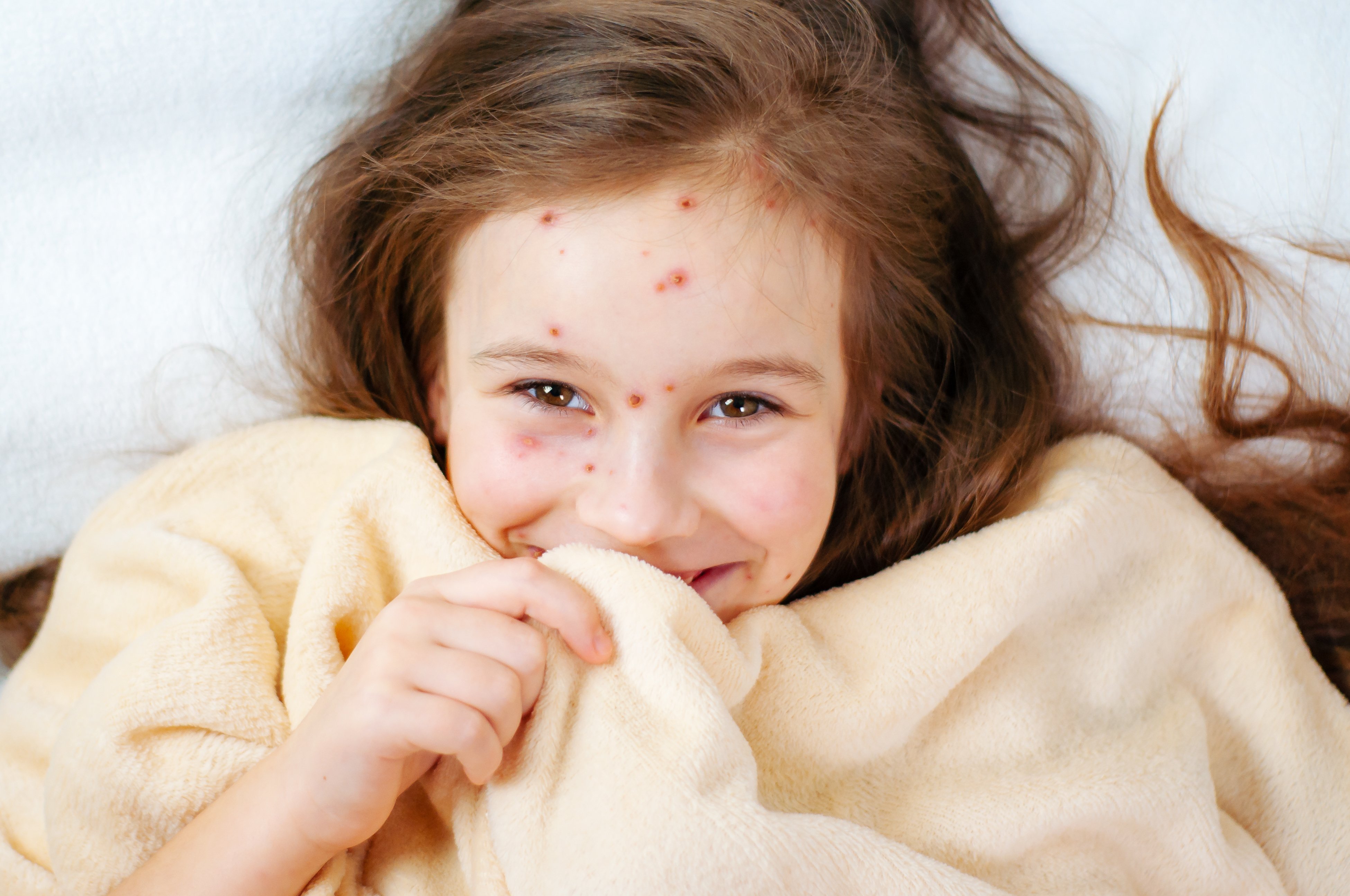 Une fillette atteint de la varicelle. | Photo : Shutterstock