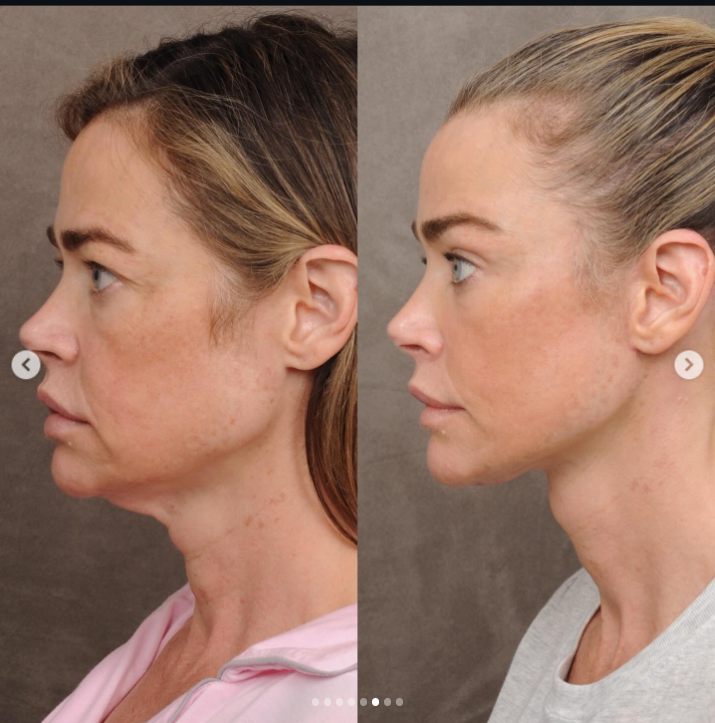Denise Richards' before and after — Profile (side) view | Source: Instagram/drbentalei | deniserichards