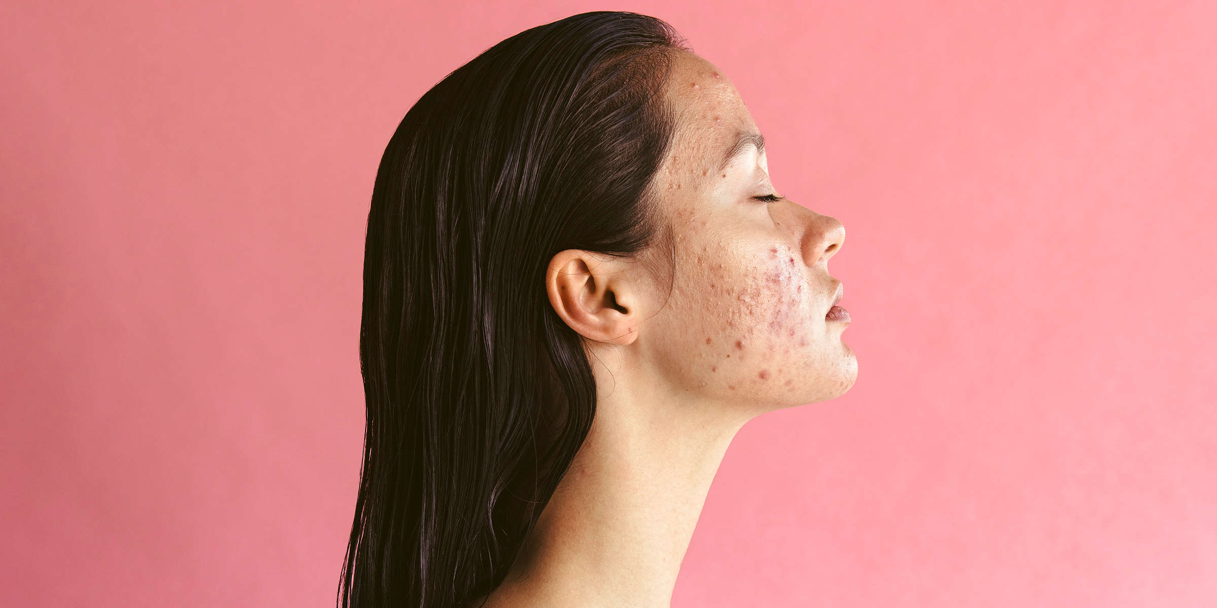 A model with a bad outbreak of acne. | Source: Shutterstock
