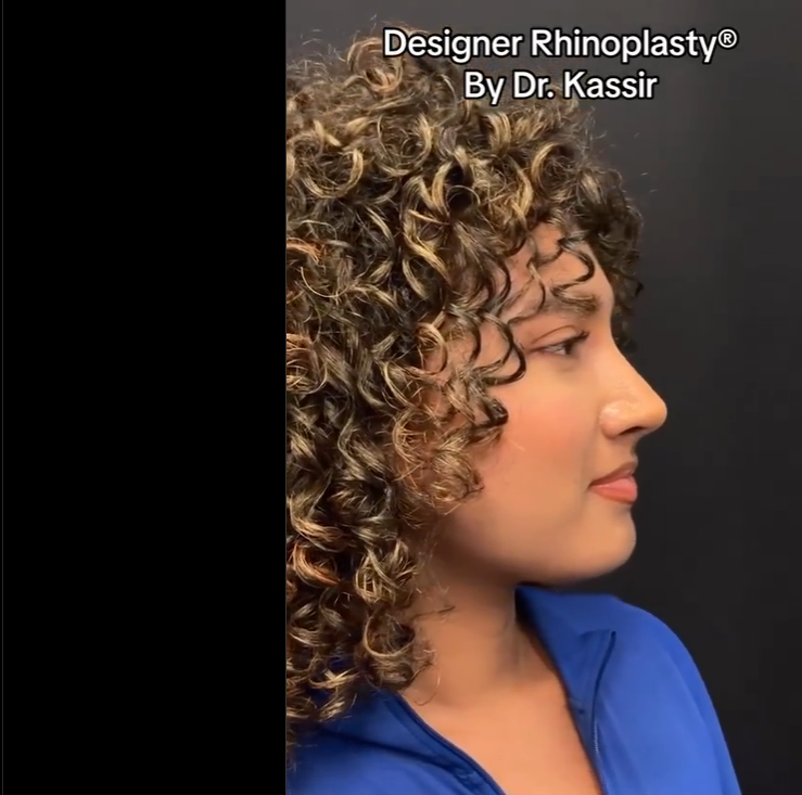 The patient shows off her nose after rhinoplasty, dated August 24, 2023 | Source: Instagram/drkassir