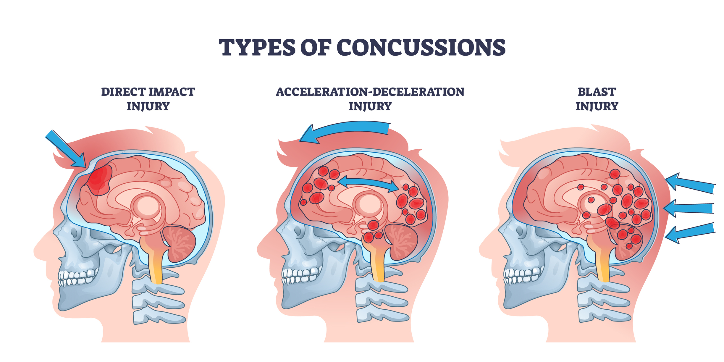 An image of a concussion and head trauma or injury types from a medical diagram | Source: Getty Images