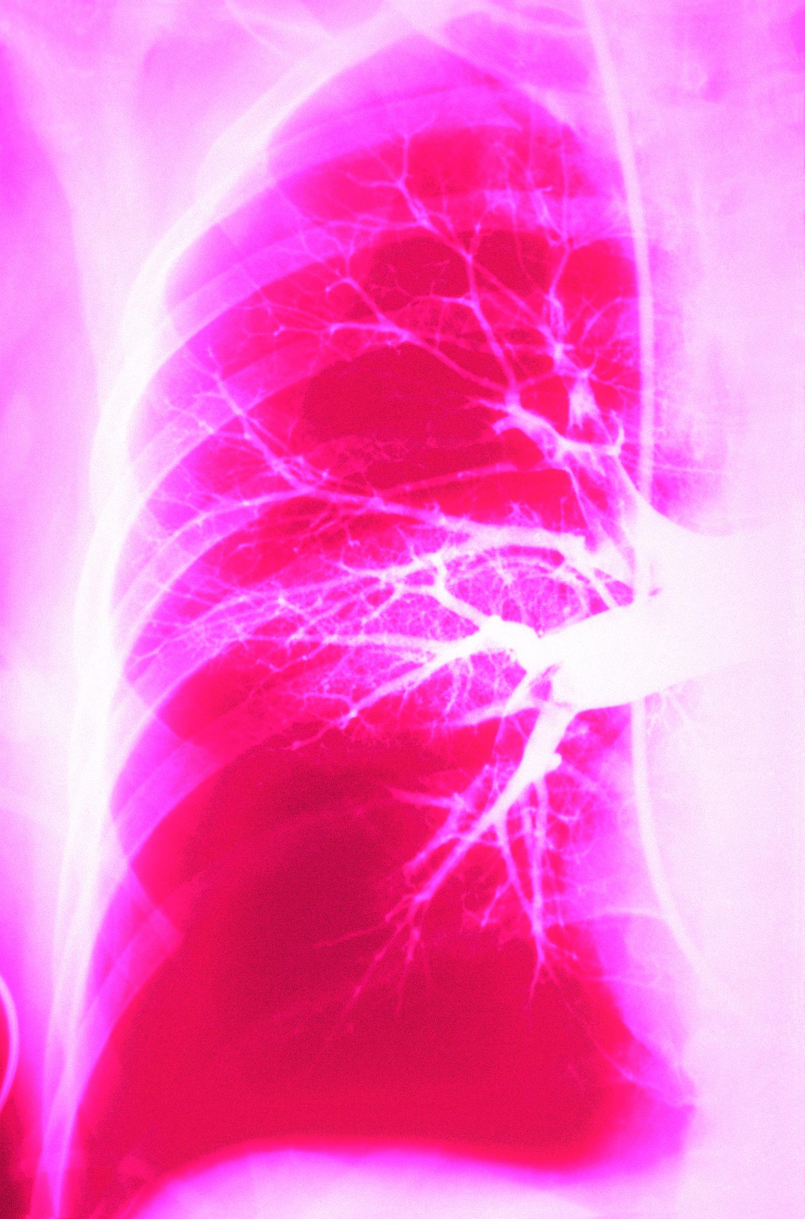 Pulmonary embolism shown in a thoracic X-ray. This condition occurs when a blood clot blocks the pulmonary artery, often originating from deep vein thrombosis in the legs or pelvis. | Source: Getty Images
