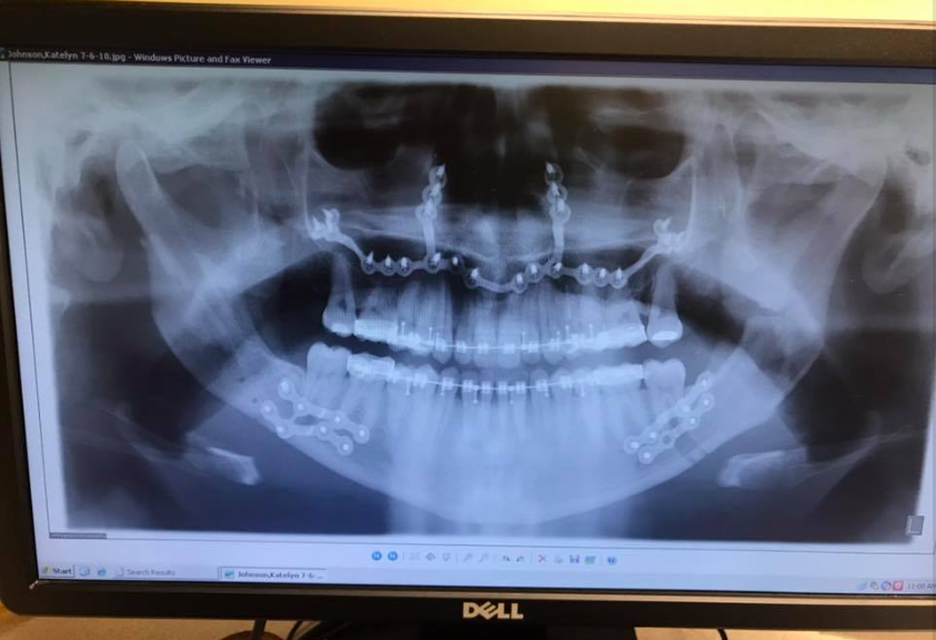 Katie Wolferding's X-ray scan, dated June 2019 | Source: Facebook/katiewolferding