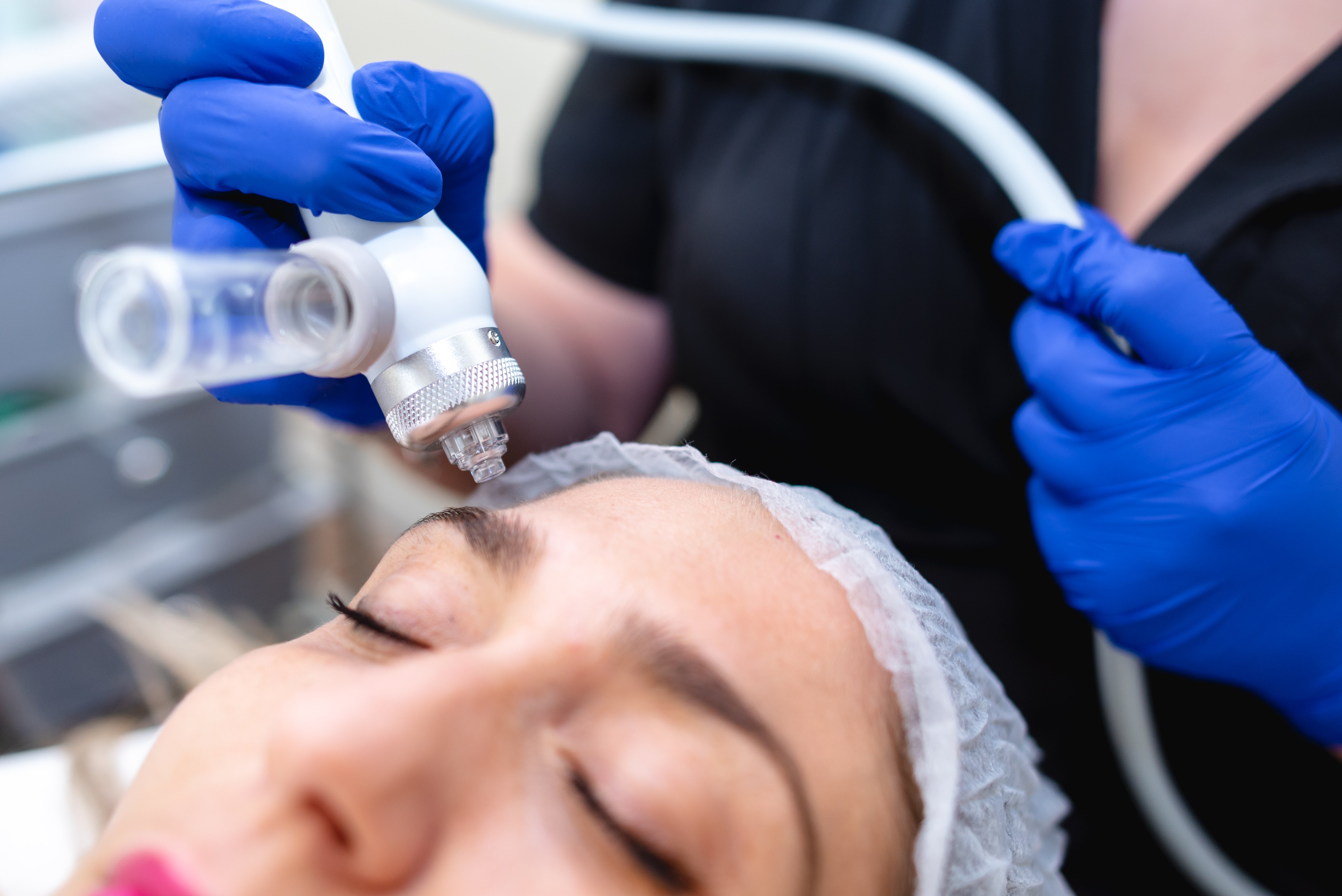 Woman undergoing microneedling procedure. | Source: Getty Images