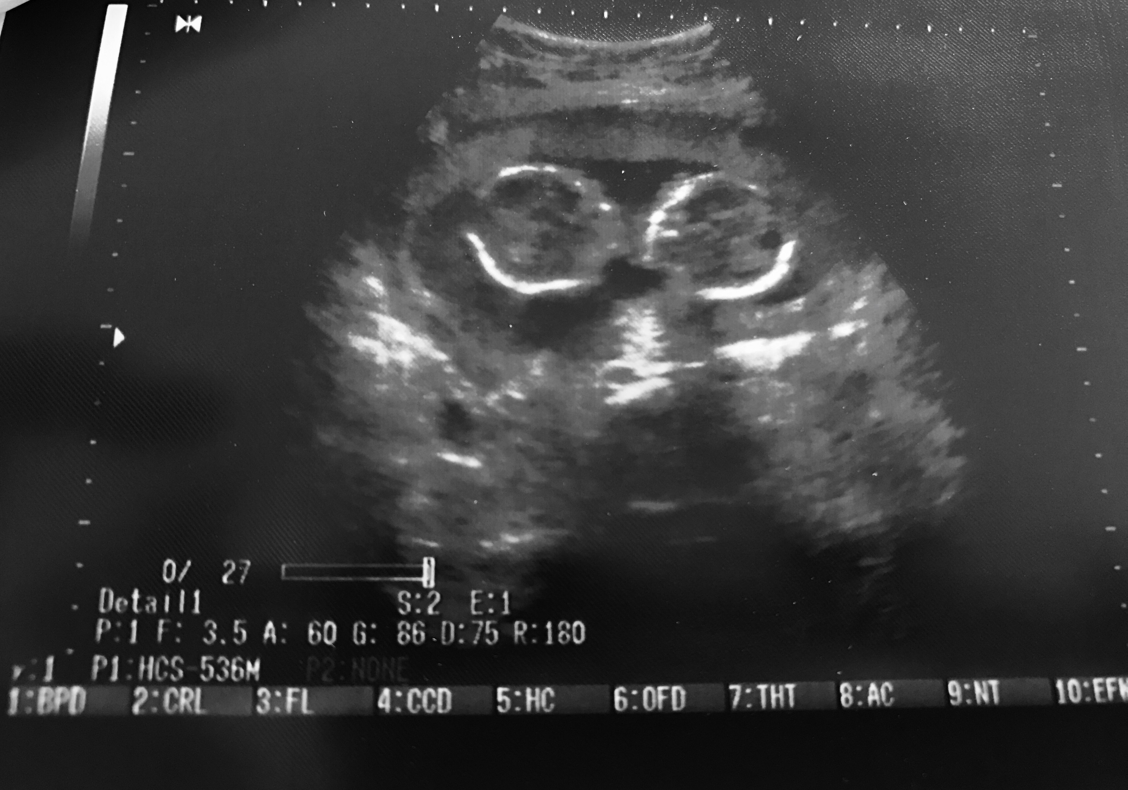 An abnormal twin pregnancy | Photo: Shutterstock An abnormal twin pregnancy | Photo: Shutterstock