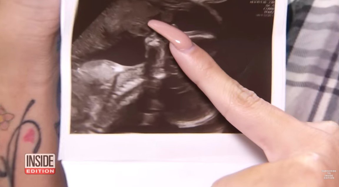 Picture of Shantel Carrillo pointing at her ultrasound photo | Source: Youtube/ Inside Edition