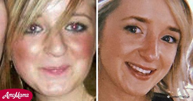 Une femme victime d'intimidation pour avoir eu le nez 'Pinocchio' a dû débourser 23 000 $ pour corriger sa première rhinoplastie bâclée