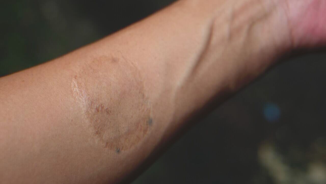 An oval-shaped scar on a woman's hand | Source: Shutterstock