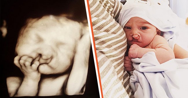 Baby Brody's ultrasound scan [left] Baby Brody who was born with a cleft lip and palate [right] | Photo: instagram.com/saheller