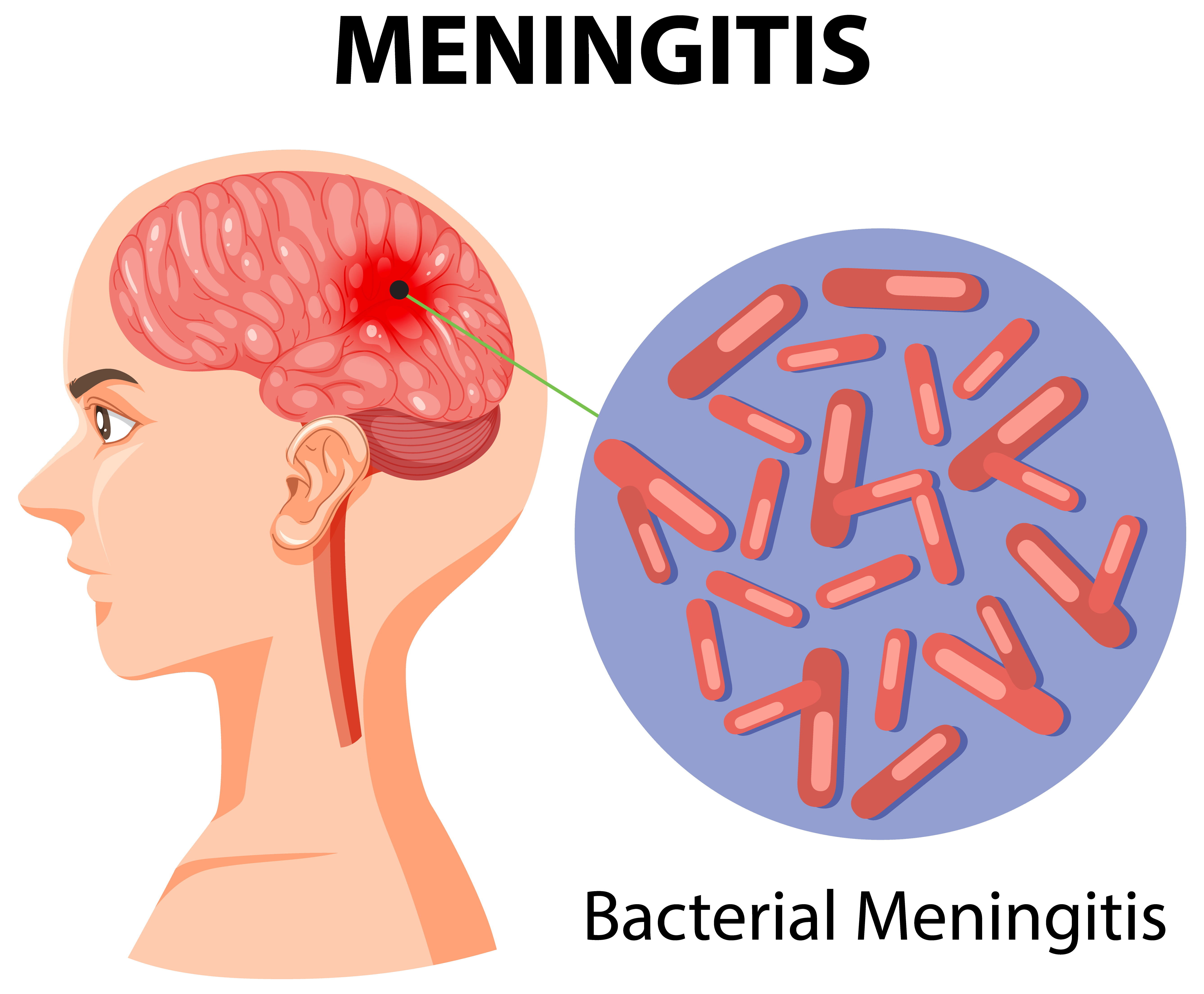 Diagram showing a brain infected with meningitis | Source: Getty images