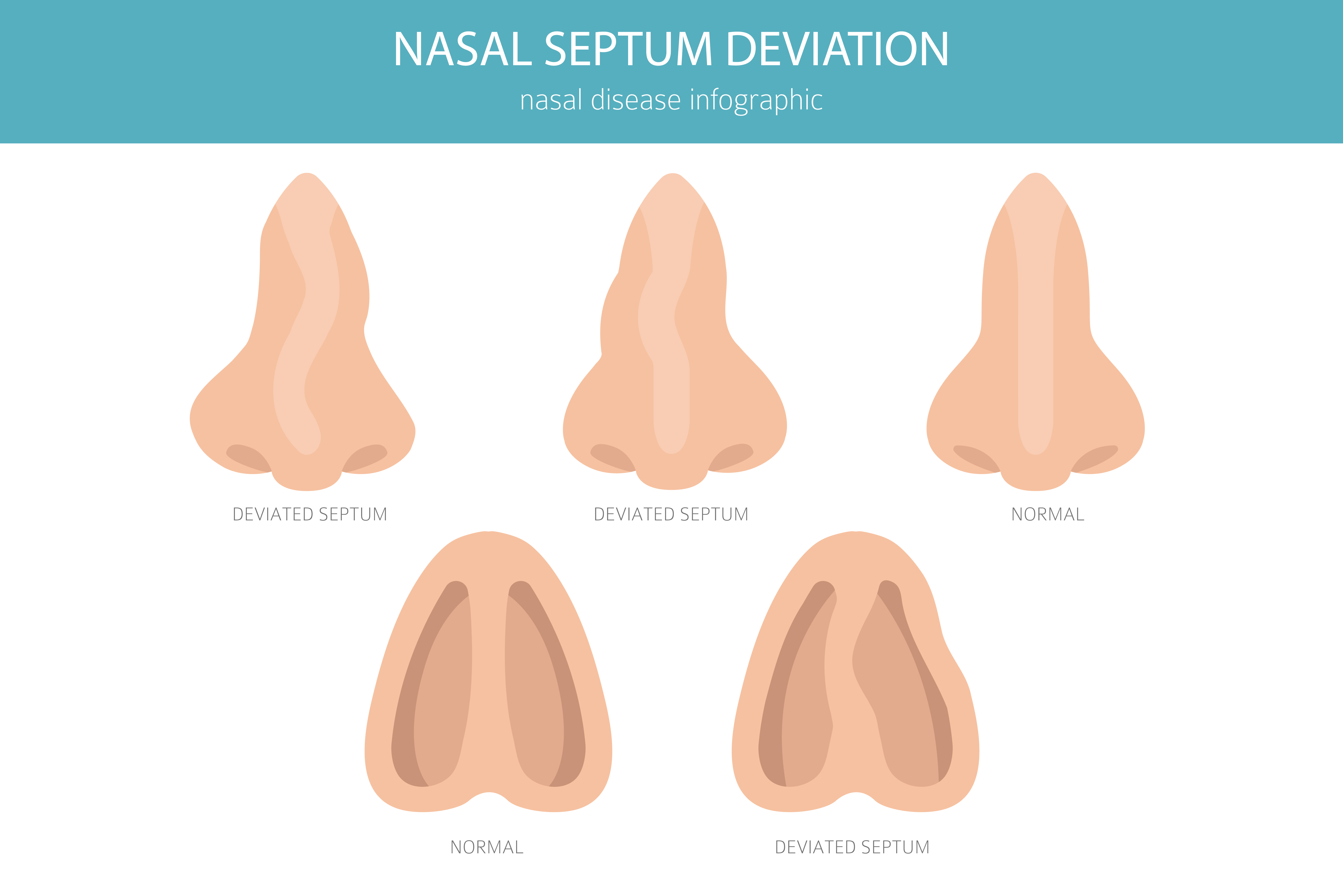 A vector illustration of nose with deviated septum | Source: Getty Images