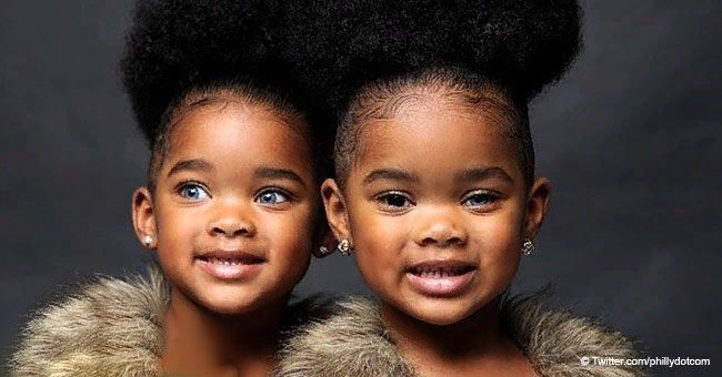 Twin girls who became famous because of their unique eye color are all grown up now