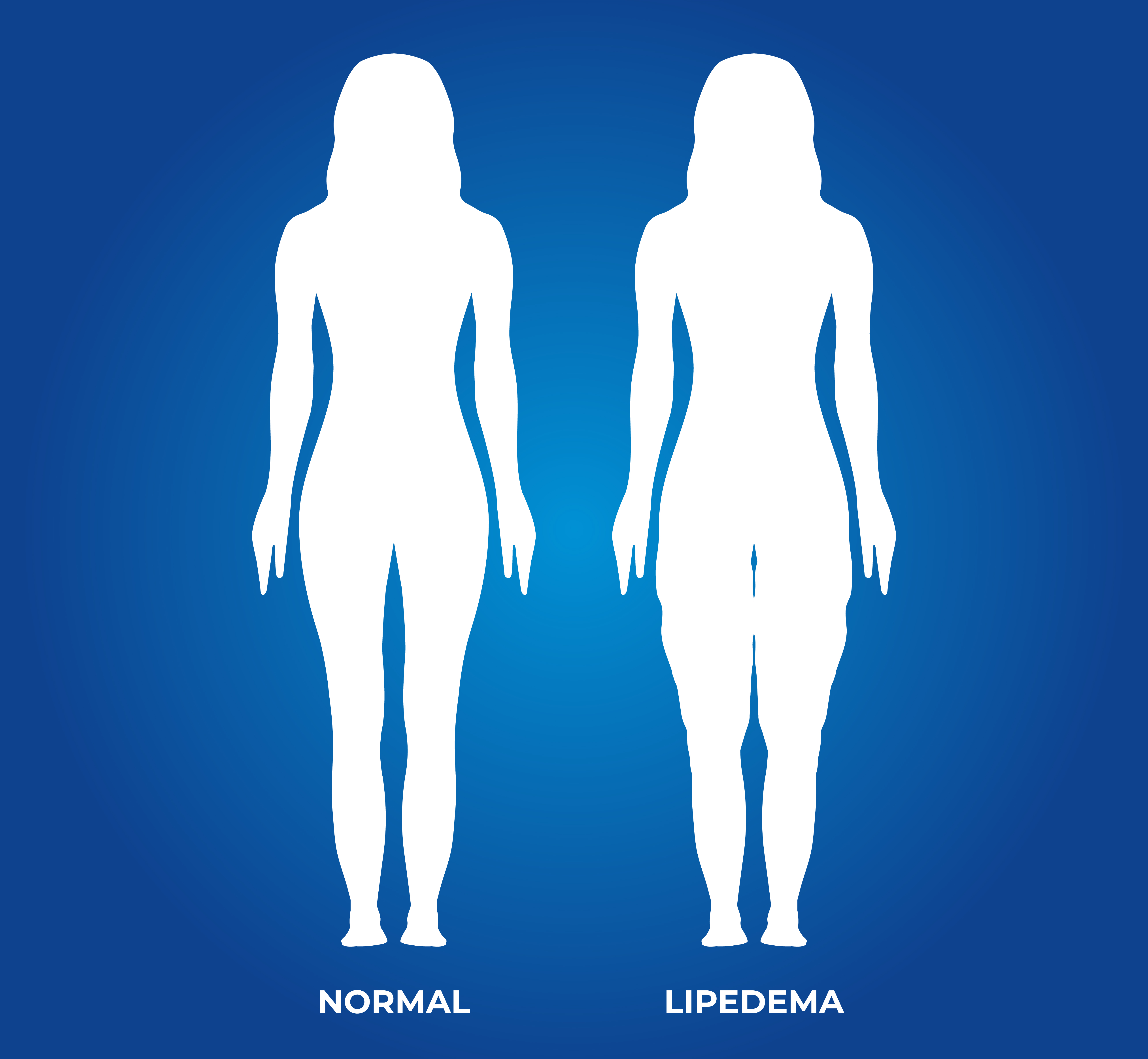 Silhouette illustration of a woman, comparing normal legs with the effects of Lipedema | Source: Getty Images