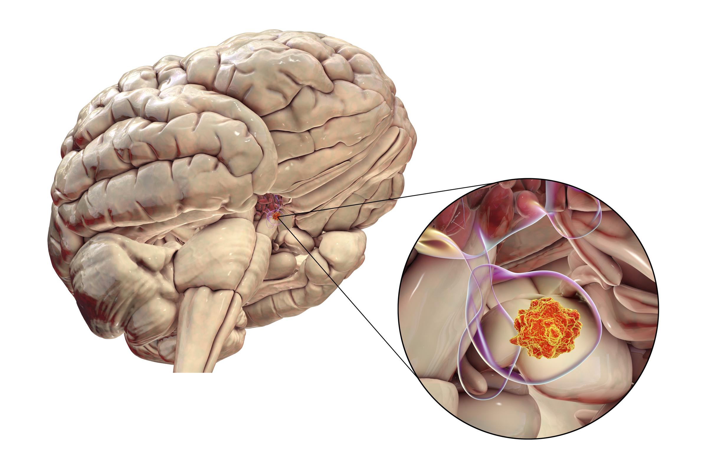 Computer-generated illustration of a pituitary gland tumor, highlighting its location and impact on surrounding structures | Source: Getty Images