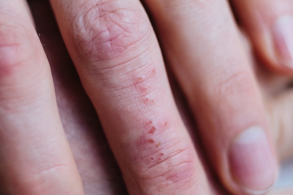 Eccema. | Foto: Shutterstock
