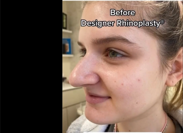 Patient pictured before rhinoplasty, dated September 30, 2022 | Source: Instagram/drkassir