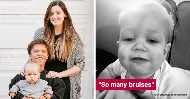 Tori Roloff shares a video of her son Jackson, but people show concern about the baby's bruises