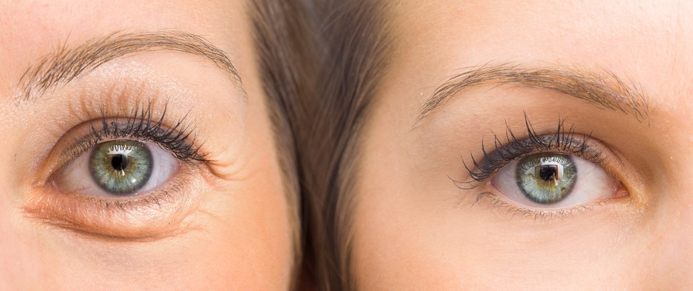 Fotos de ojos antes y después de un tratamiento para las arrugas. Fuente: Shutterstock