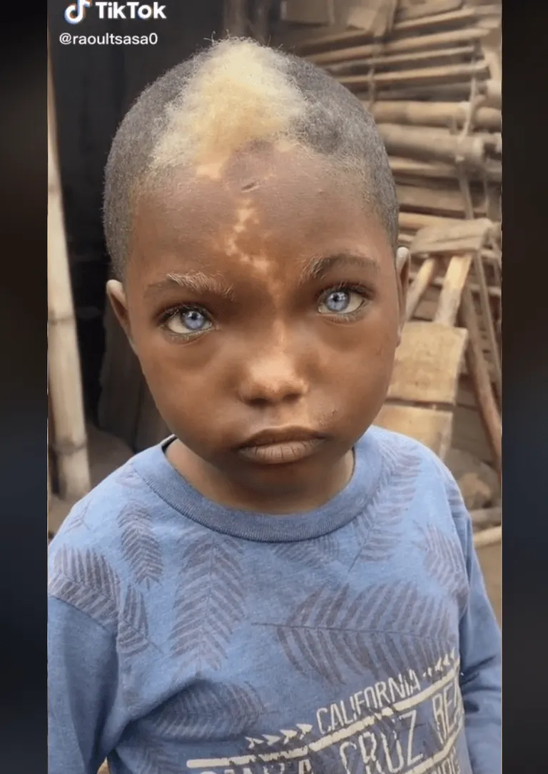 Le garçon noir aux yeux bleus avec une tache de naissance en forme d'éclair et des cheveux blancs | Source : tiktok.com/@raoultsasa0