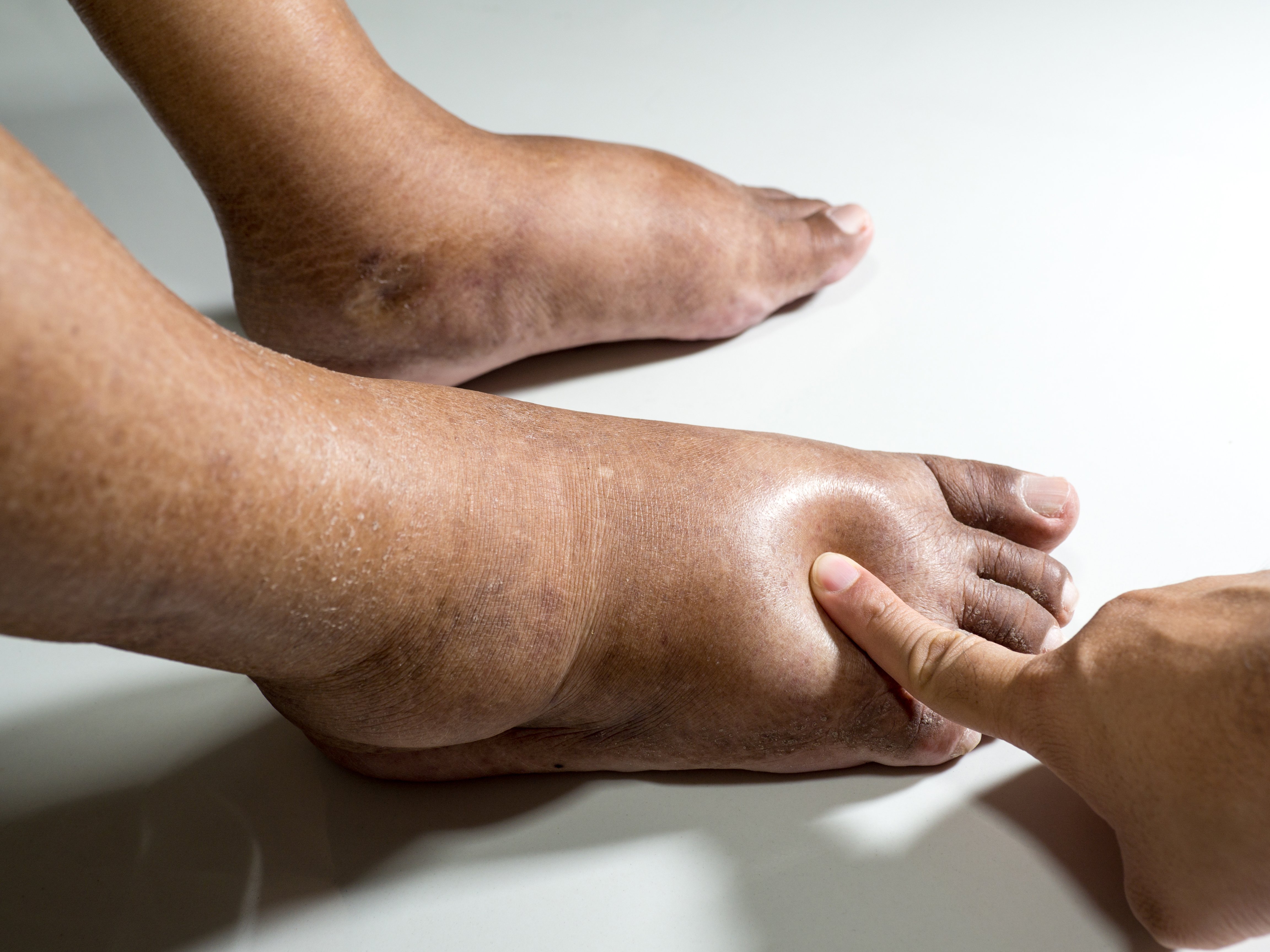 Muejr con piernas y pies hinchados | Foto: Shutterstock