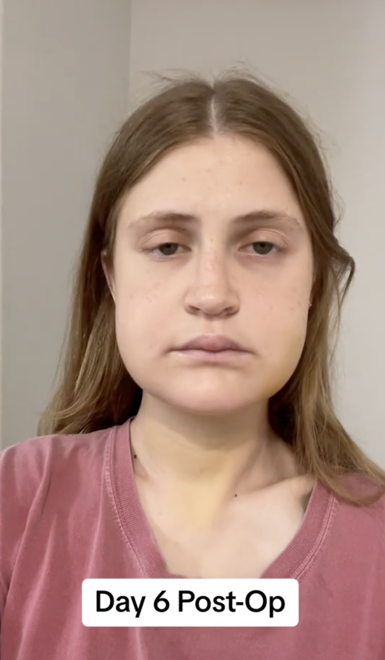 Virginia Elder documents Day 6 post-op with a still and centered selfie. | Source: TikTok/virginiaeelder